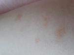 Кровоподтеки на ногах после укусов насекомых фото 2