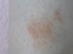 Кровоподтеки на ногах после укусов насекомых фото 1