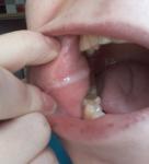 Проблемы слизистой рта, белые полосы на щеках и губах фото 2