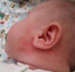 Аллергия у ребенка в 3 месяца фото 1
