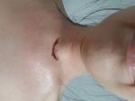 Рубец после удаления щитовидной фото 1