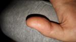 Воспаления на пальцах фото 1