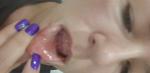 Высыпания на внутренней стороне губы фото 1