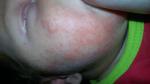 Акне или аллергия фото 2