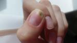 Отслоения ногтя после гель-лака фото 1