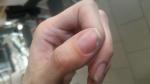 Отслоения ногтя после гель-лака фото 2