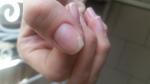 Отслоения ногтя после гель-лака фото 3