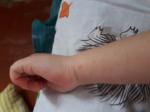 Сыпь у ребенка на ладошках руках и выше колена фото 3