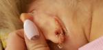 Мокнущие кроваточащие раны за ушами у ребенка 4,5 лет фото 1