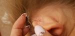Мокнущие кроваточащие раны за ушами у ребенка 4,5 лет фото 2