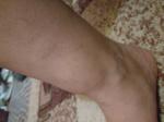 Припухлость на ноге в районе голени, не болит и не чешется фото 1
