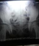 Описание рентгена тазобедренных суставов фото 1