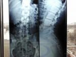Рентген пояснично-крестцового отдела позвоночника с функциональными пробами фото 1
