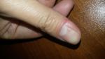 Деформация ногтя фото 1