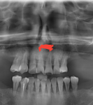 Где расположен нерв у зуба? фото 1