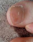 Светло-коричневое пятно на ногте пальца ноги фото 1