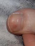 Светло-коричневое пятно на ногте пальца ноги фото 3