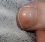 Светло-коричневое пятно на ногте пальца ноги фото 2