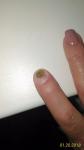 Непонятное поражение ногтя пальца руки фото 2