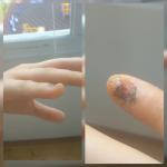 Травма ногтевого ложа фото 1