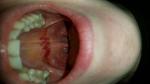 Красные пятна на небе аллергия от стоматологии или вирус фото 1