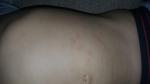 Сыпь у ребенка на теле с левой стороны фото 2