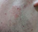 Воспаление кожи лица фото 5