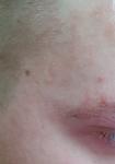 Воспаление кожи лица фото 3
