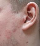Воспаление кожи лица фото 1