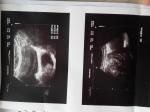Миома матки с узлом яичника фото 1