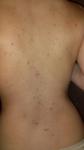 Сыпь на спине и грудной клетке фото 1