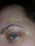 Увеличивающаяся сыпь под глазом, покраснение(аллергия на паука) фото 1