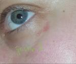 Увеличивающаяся сыпь под глазом, покраснение(аллергия на паука) фото 2