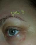 Увеличивающаяся сыпь под глазом, покраснение(аллергия на паука) фото 3