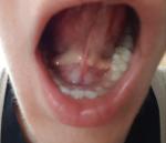Воспаление слюнных желез под языком фото 1