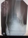 Косой перелом диафиза малоберцовой кости или нижней части лодыжки фото 3