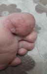 Трещины на пальцах у ребенка фото 3