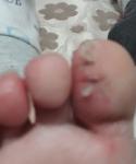 Трещины на пальцах у ребенка фото 2