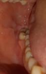 Белые пятна и травмирование слизистой полости рта фото 3