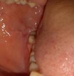Белые пятна и травмирование слизистой полости рта фото 2