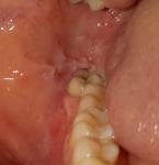 Белые пятна и травмирование слизистой полости рта фото 1