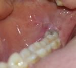 Белые пятна и травмирование слизистой полости рта фото 4