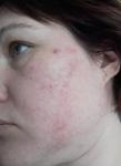 Сыпь на лице, постоянное ухудшение в течение года фото 2
