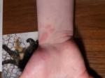 Повторная сыпь у ребёнка 7 лет на руках и ногах фото 1