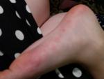 Повторная сыпь у ребёнка 7 лет на руках и ногах фото 4
