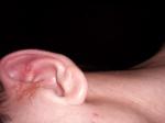 Болячки на коже лица, шеи и уха фото 3
