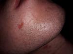 Болячки на коже лица, шеи и уха фото 2