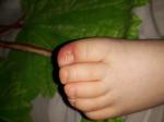 Опухоль на пальце ноги у ногтя фото 2