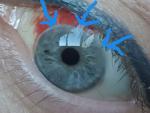 Глаз после операции по замене хрусталика фото 2