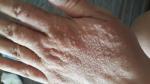 Аллергия на рукеи пальцах фото 1